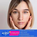 gel-secativo-para-acne-acnezil-incolor-10g-100018522